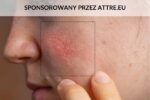 Na zdjęciu zaczerwienienie na twarzy