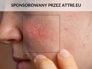 Na zdjęciu zaczerwienienie na twarzy