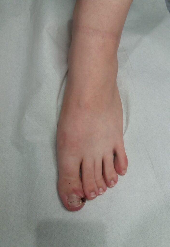 Diagnoza palca u stopy