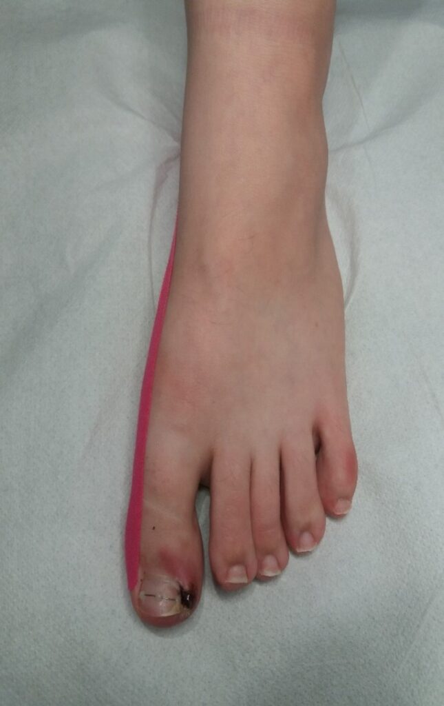 Diagnoza palca u stopy
