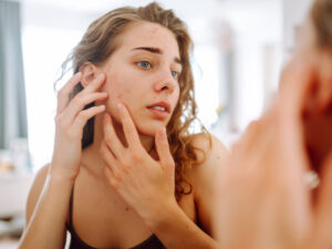 Close-up of a young woman with problem skin looking in the mirror, touching her cheek with acne. Cosmetic care. Dermatology.