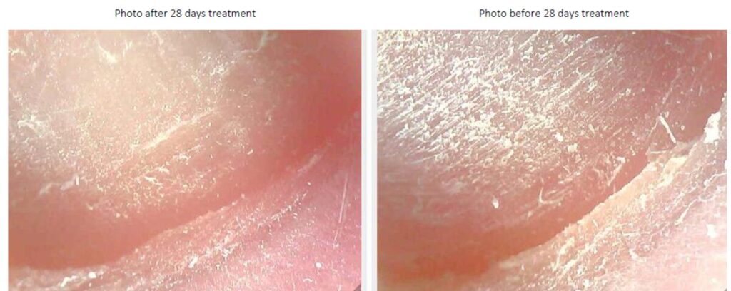 Zdjęcie z badań laboratoryjnych w 60 krotnym powiększeniu płytki paznokcia przed i po pełnej kuracji. 