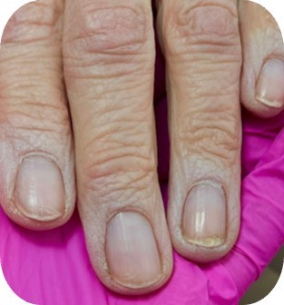 Zniszczone paznokcie