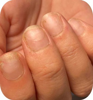 zniszczone paznokcie