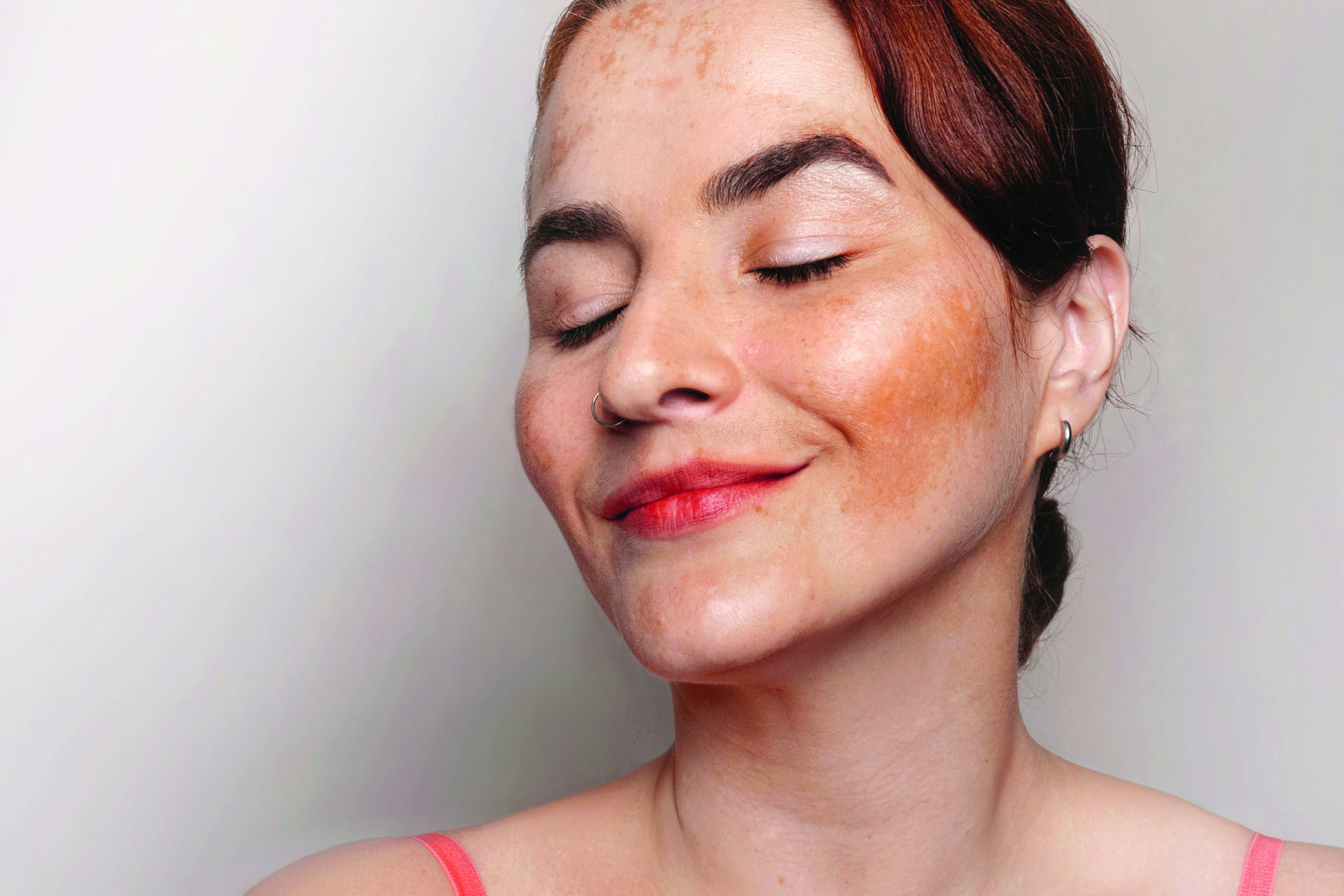 Kobieta uśmiecha się i podoba jej się jej twarz z przebarwieniami, melasą, piegami i plamami starczymi. Zdjęcie z bliska.