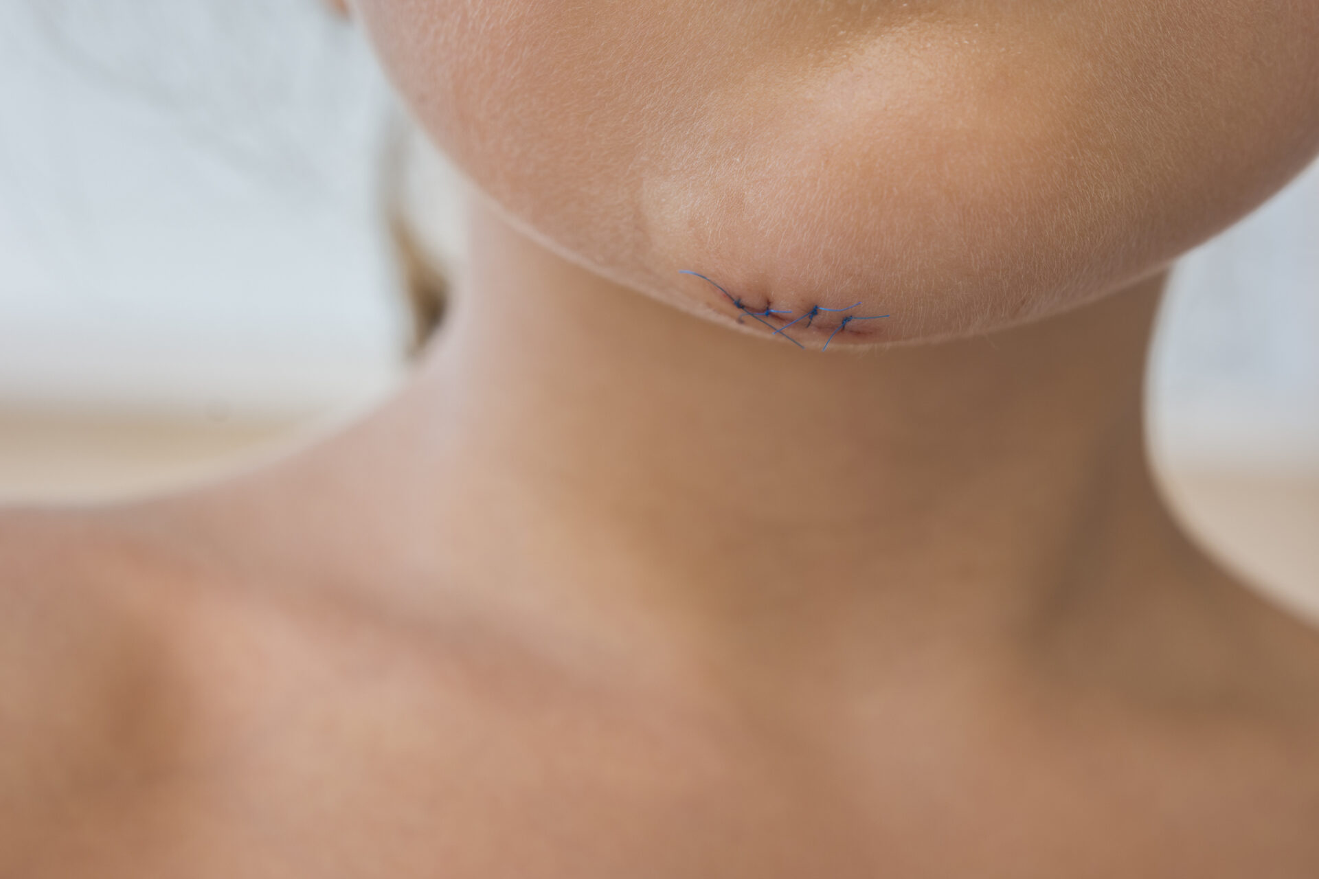 Terapia blizn po oparzeniu u dzieci