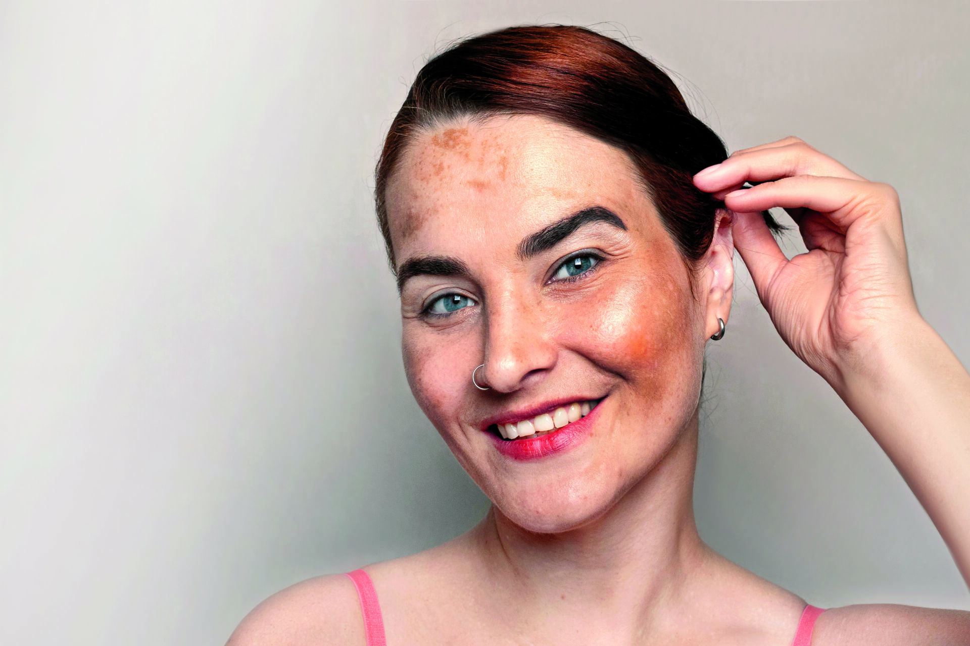 Melasma – wyzwanie dla kosmetologa, cz.3