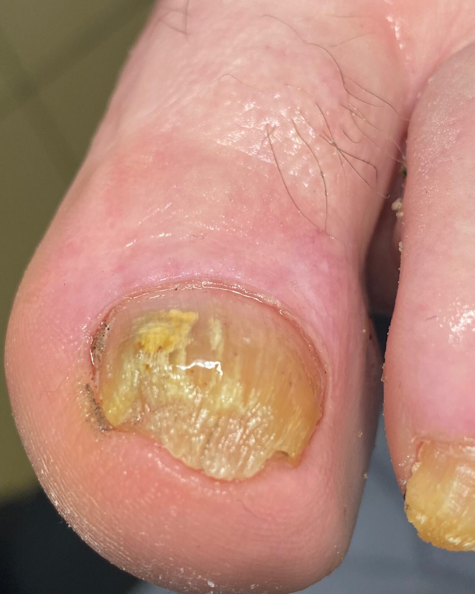 Dermatofitoma w przebiegu infekcji Trichophyton Rubrum 2