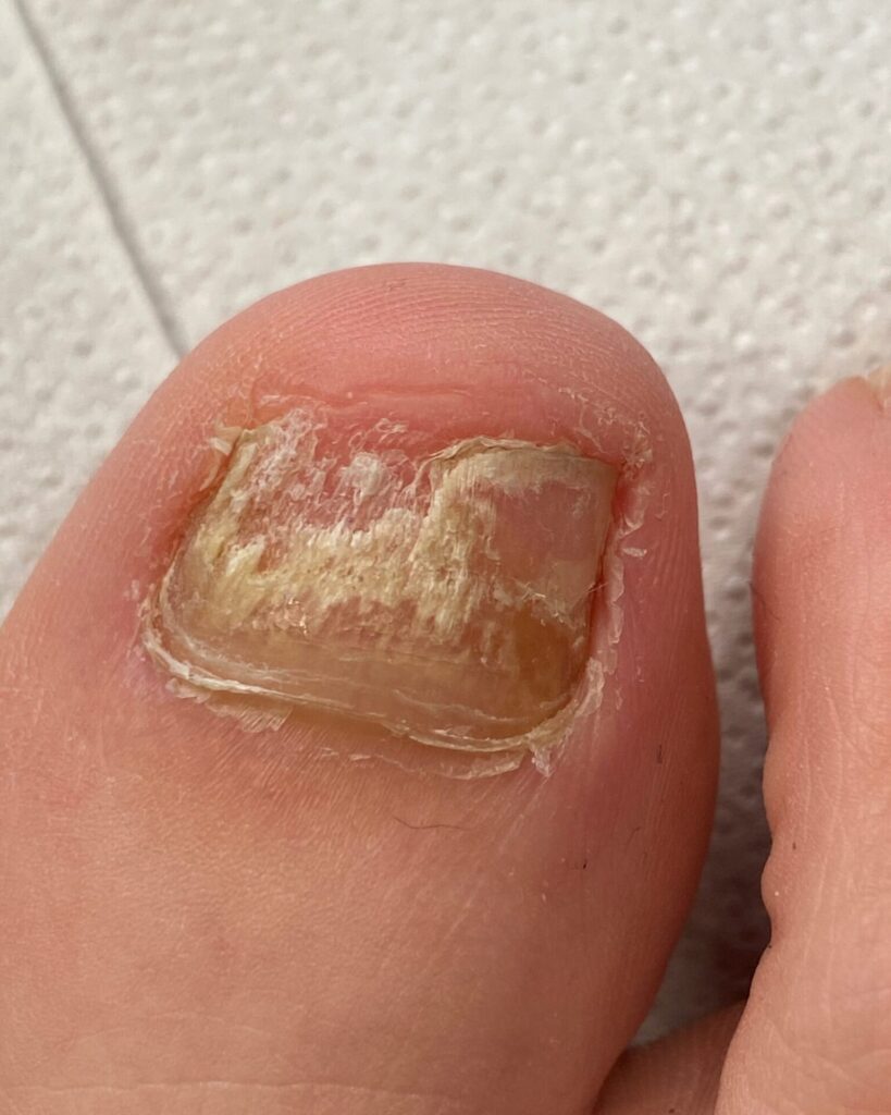 Infekcja Trychophyton Robrum u pacjenta na immunosupresji