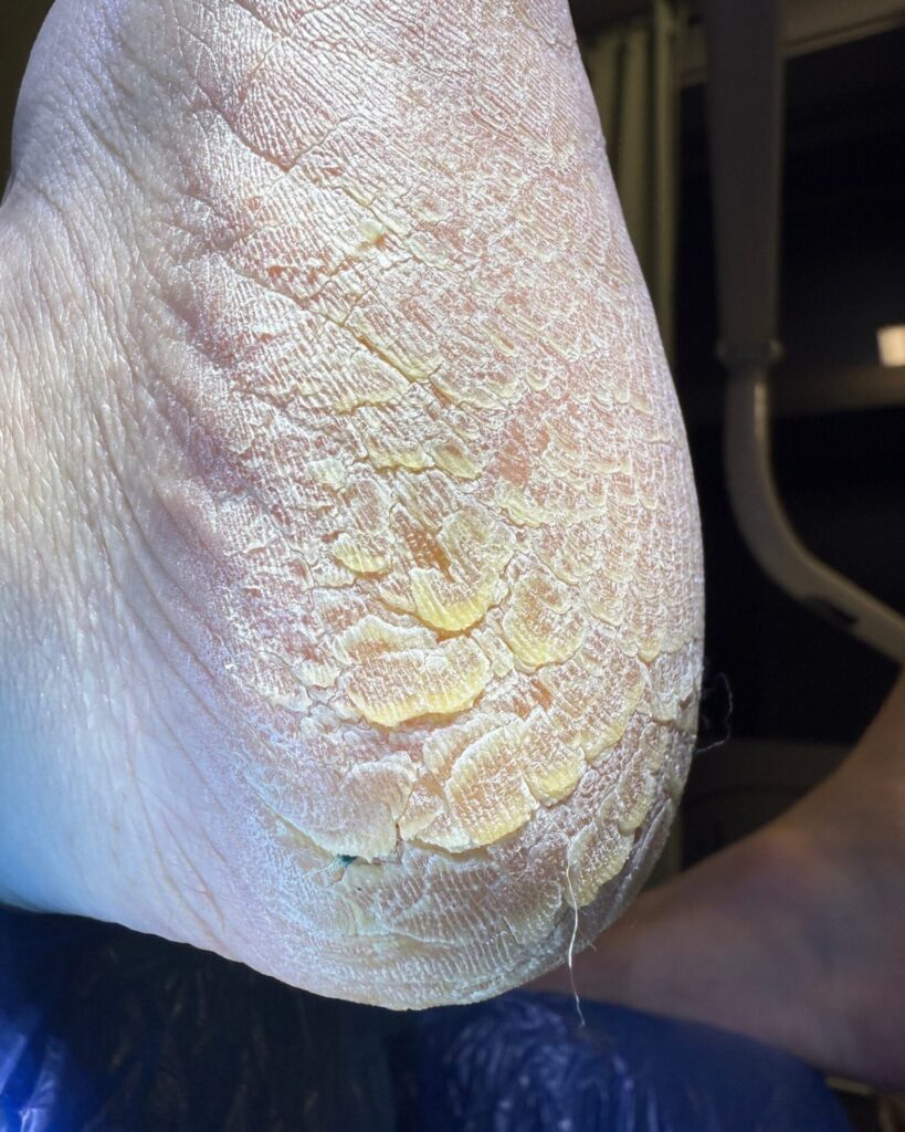 Infekcja skóry - Trihophyton Rubrum