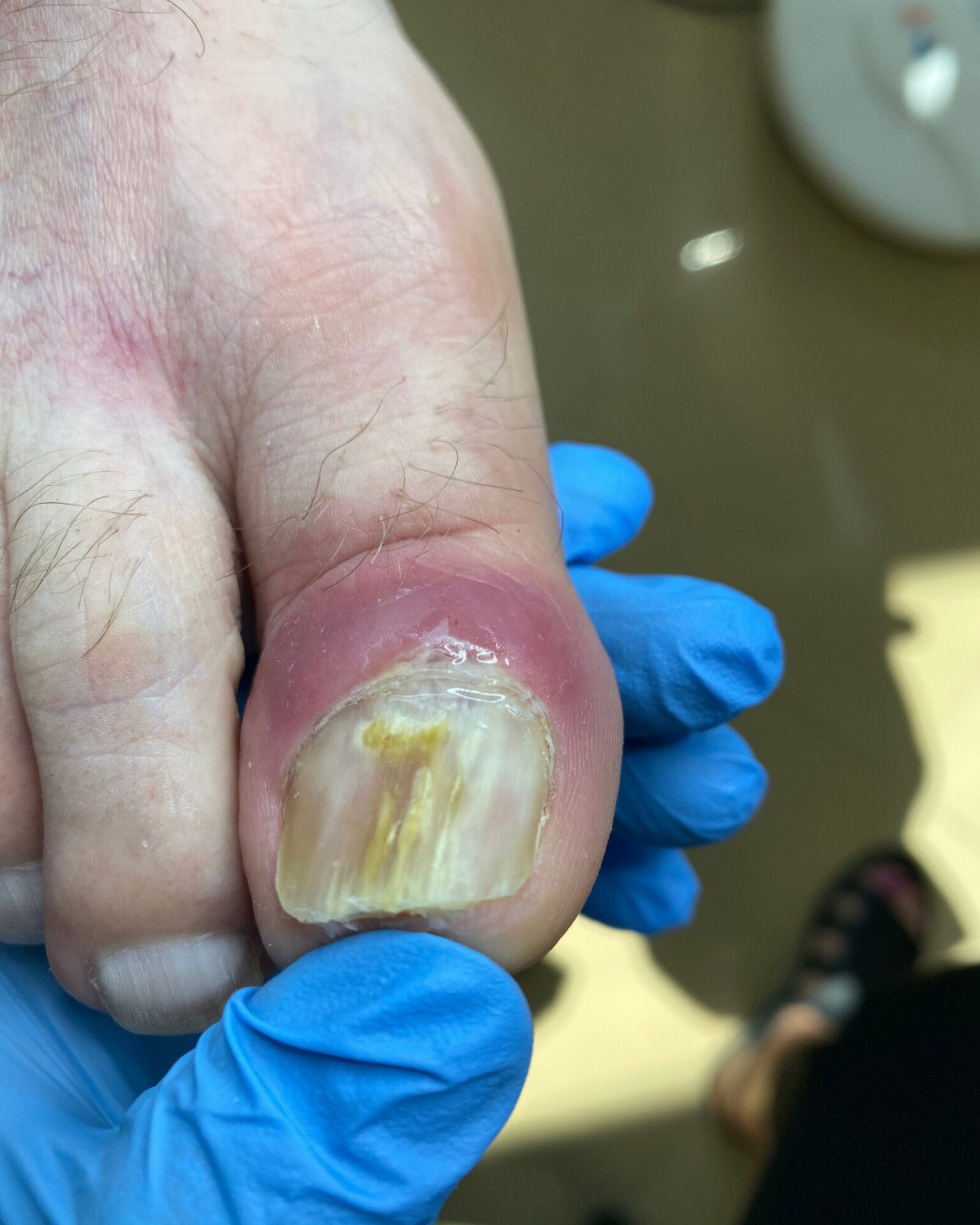 dermatofitoma w przebiegu infekcji trichophyton rubrum