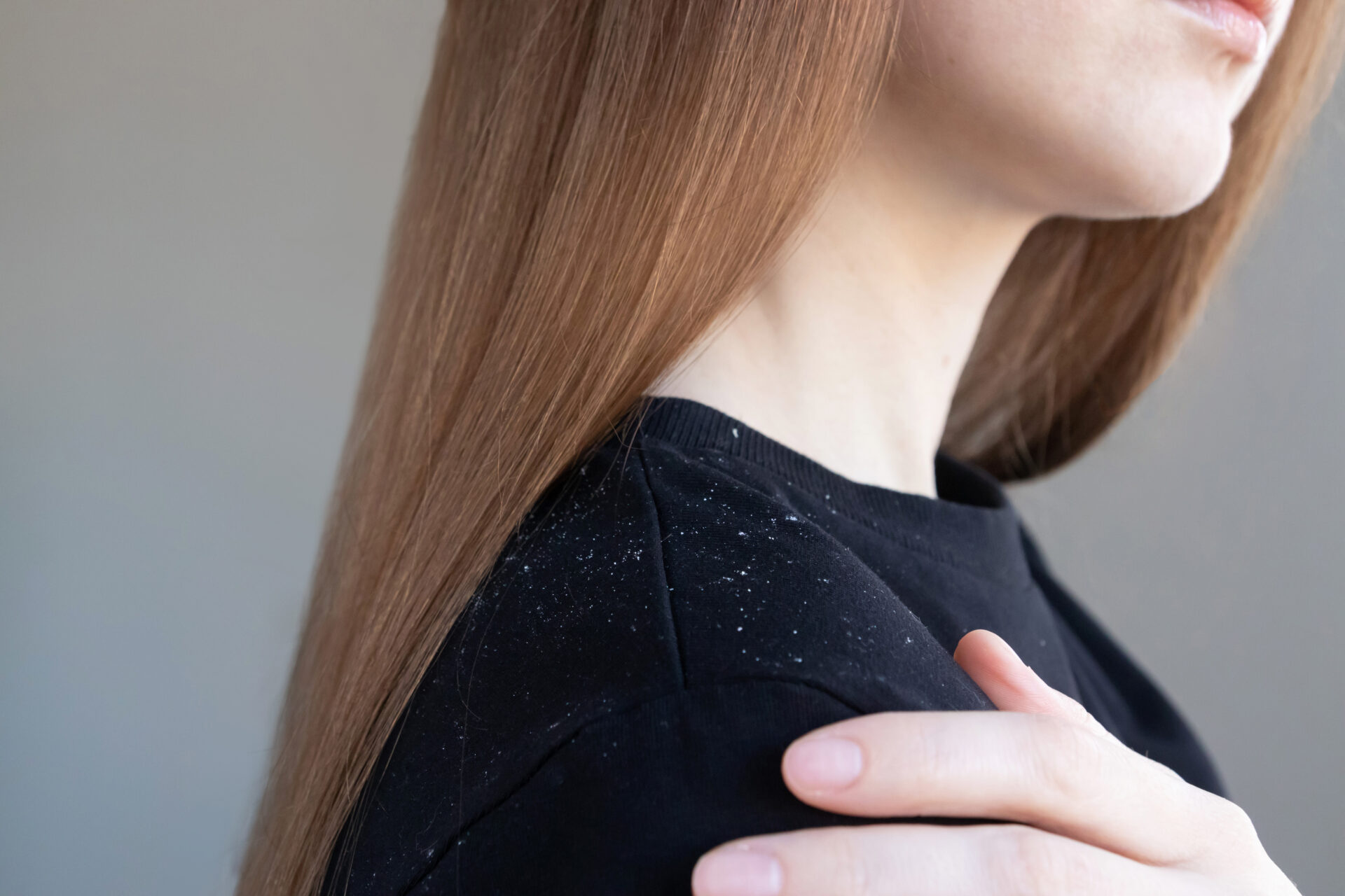 Zbliżenie na łupież na ramieniu kobiety. Problem z łojotokiem.