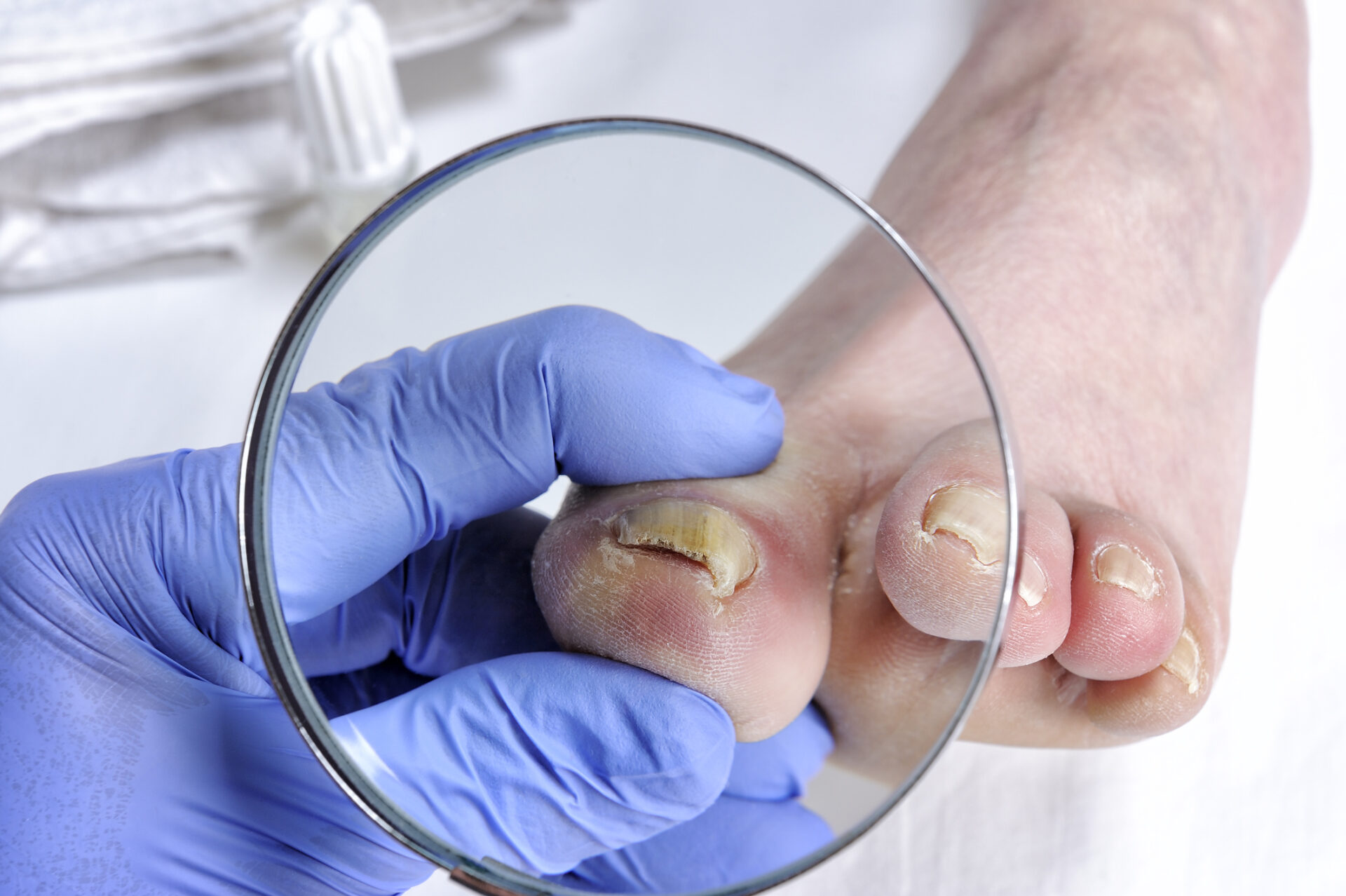 Dermatolog bada paznokcie pacjenta dotkniętego grzybicą paznokci spowodowaną przez grzyby chorobotwórcze.
