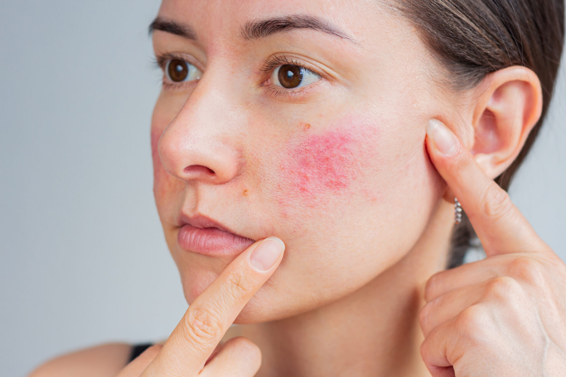 Młoda kobieta cierpiąca na trądzik różowaty twarzy w fazie ostrej. Problemy dermatologiczne. Przewlekła choroba skóry